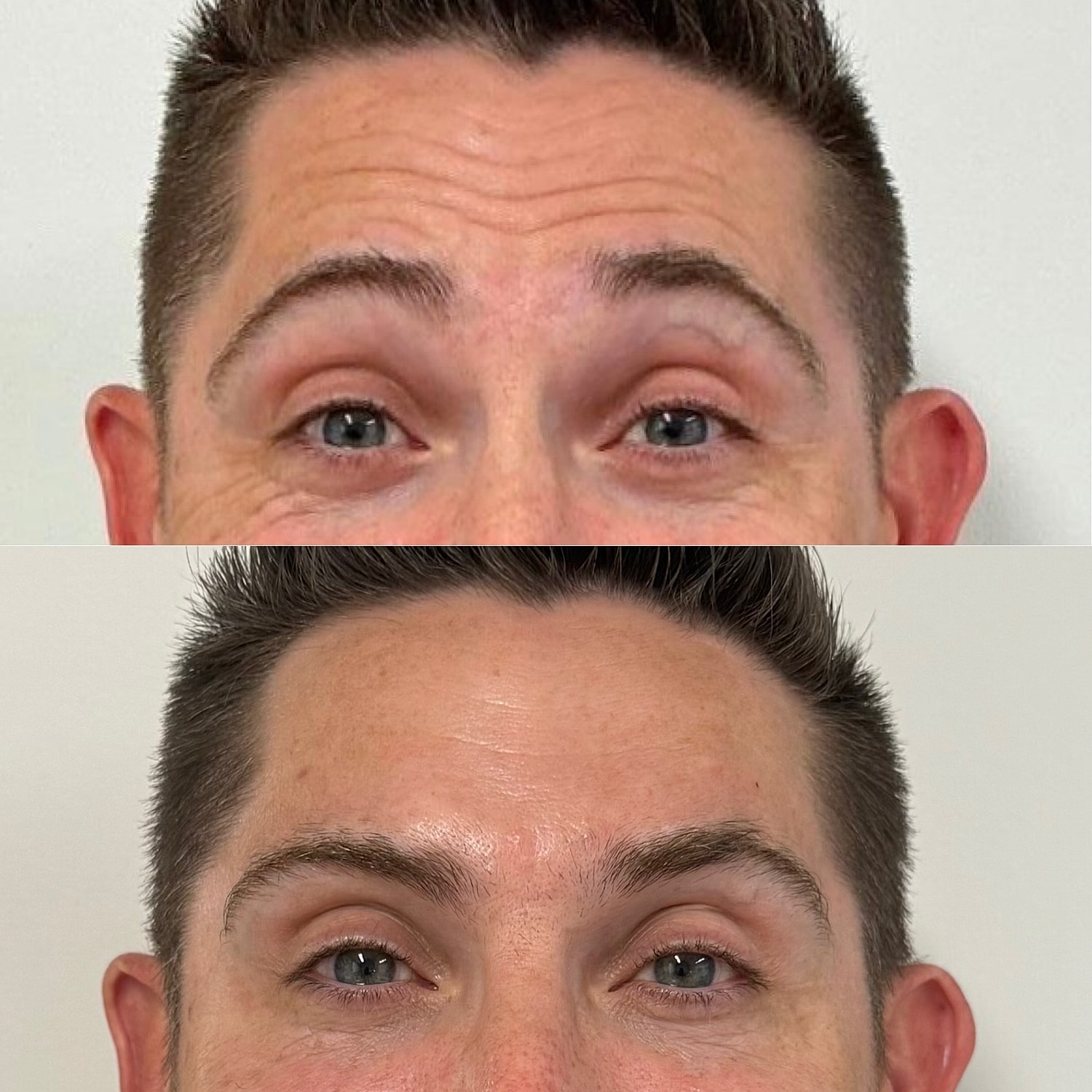 Botox Before & After