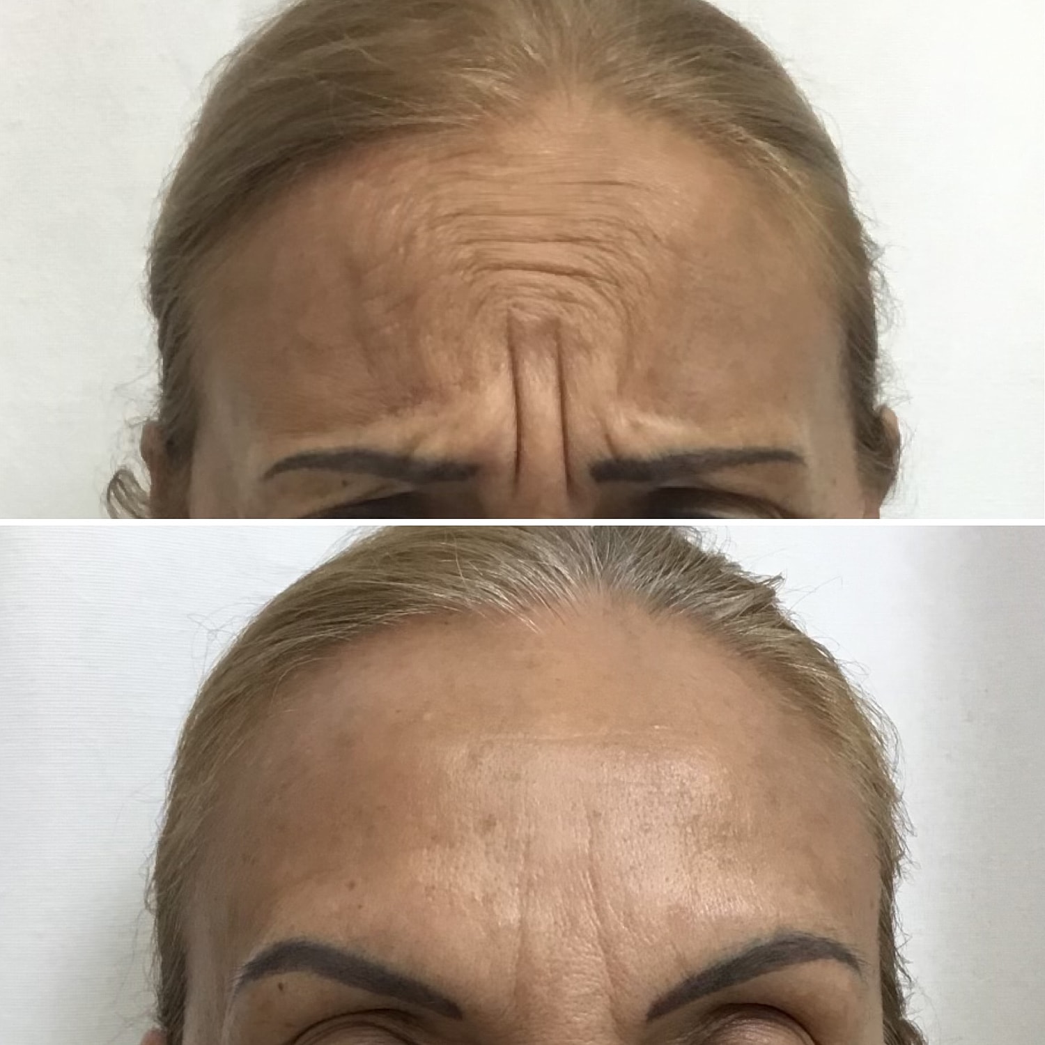 Botox Before & After