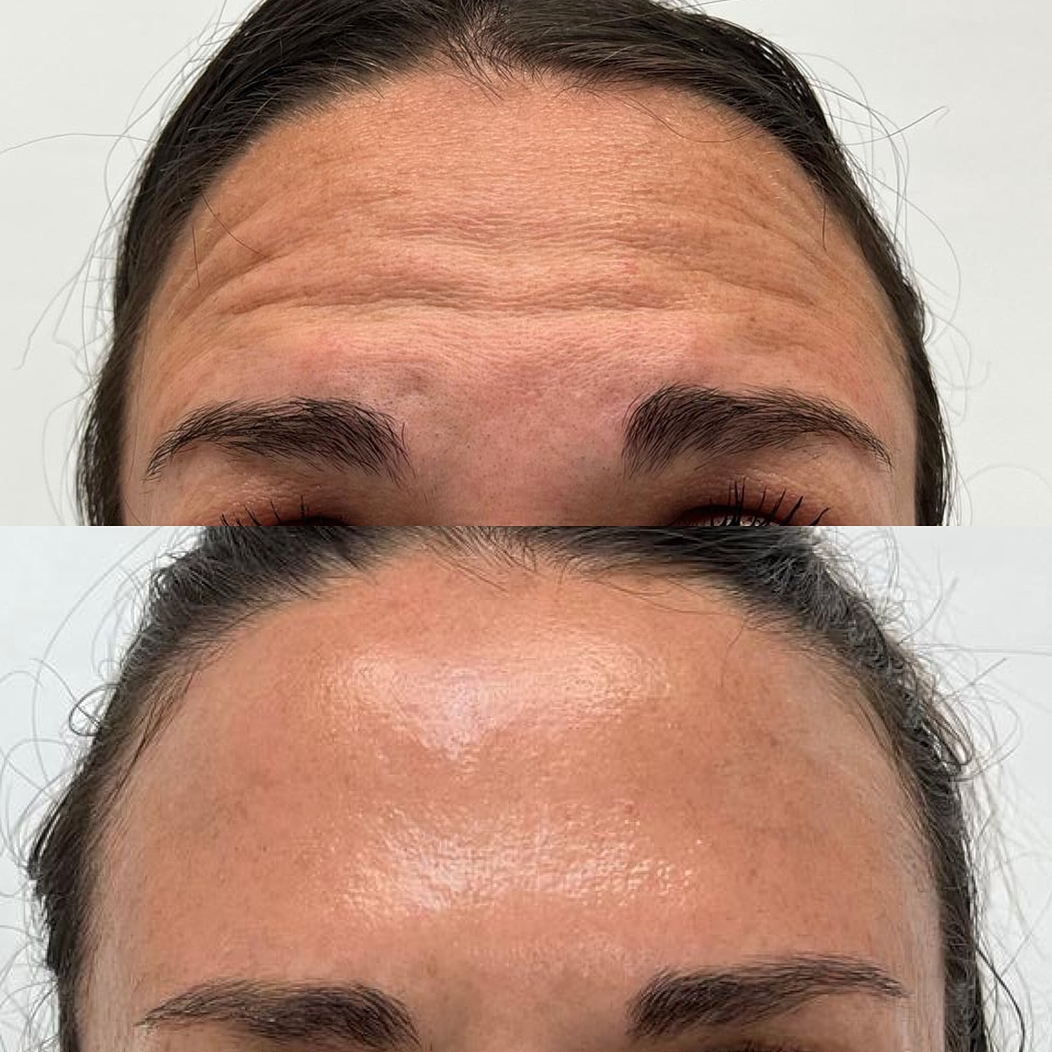 Botox Before & After