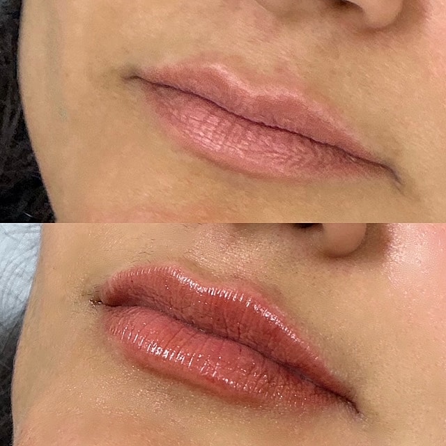 Lip Filler Before & After