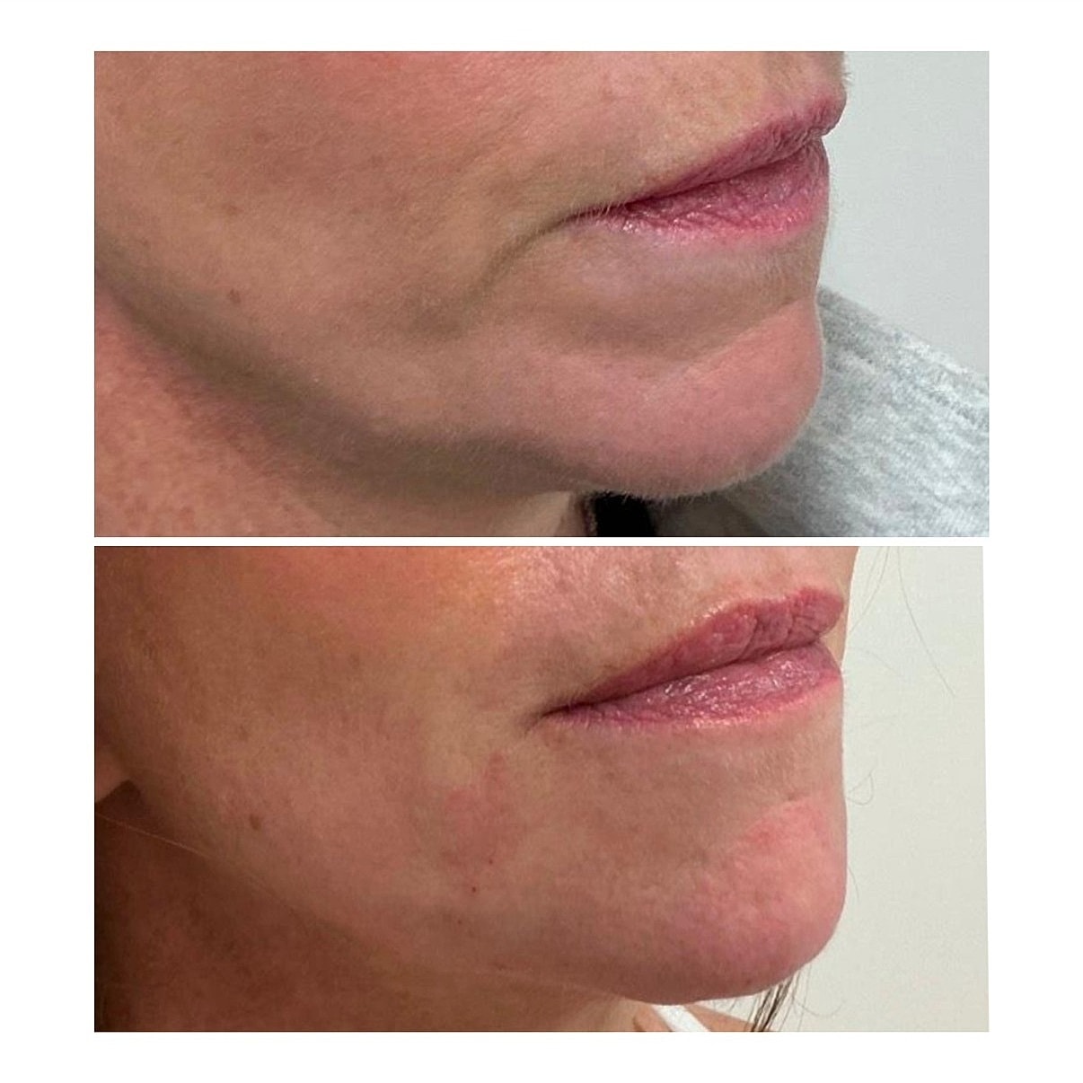 Lip Filler Before & After