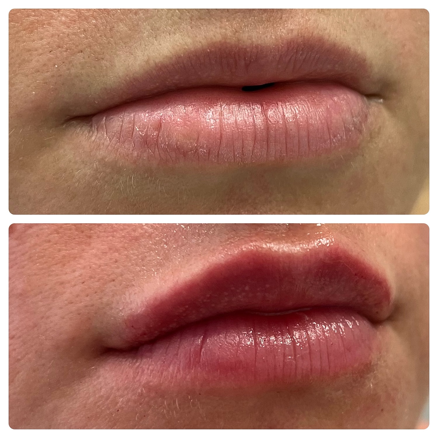 Lip Filler Before & After
