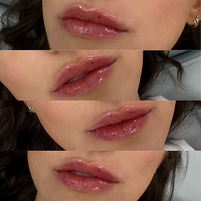 Lip Filler Before & After