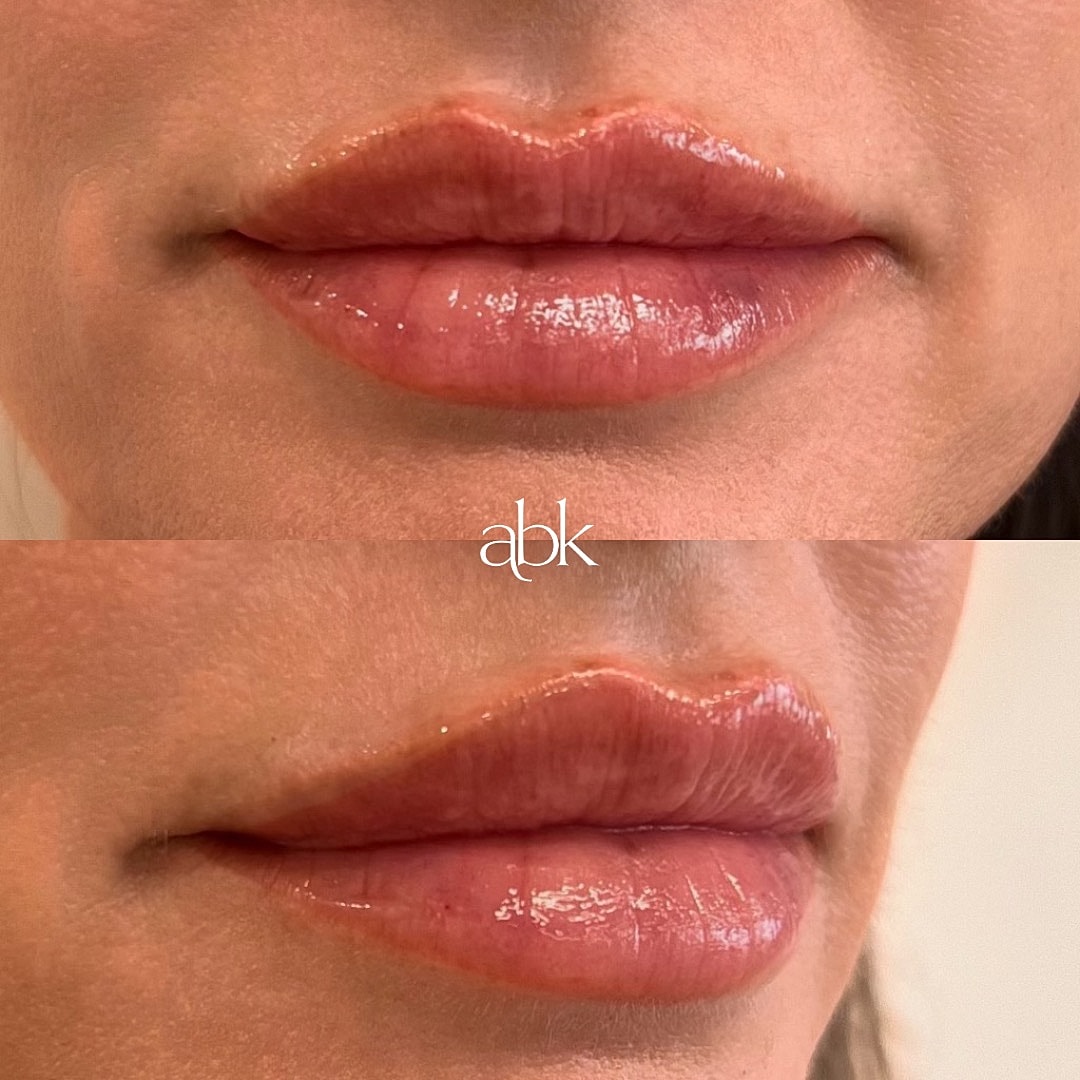 Lip Filler Before & After