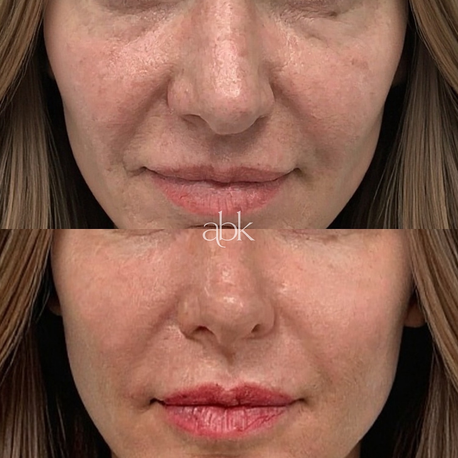Dermal Fillers Before & After