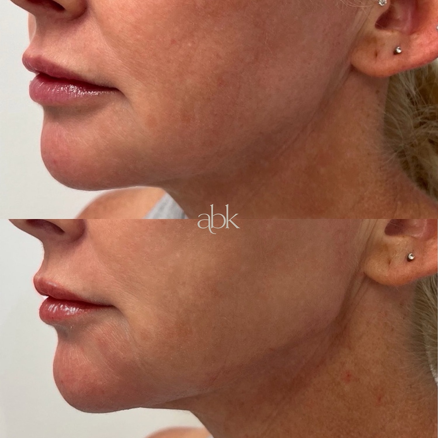 Dermal Fillers Before & After