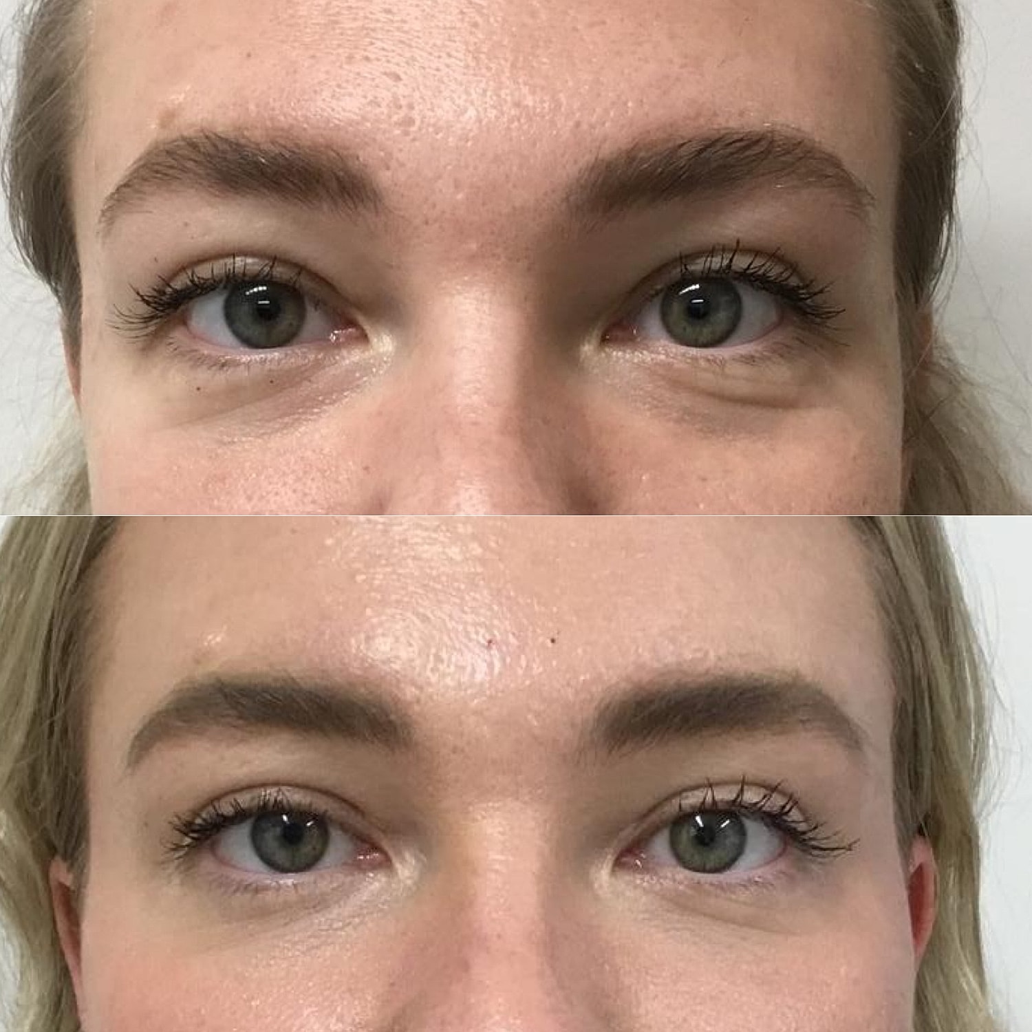 Dermal Fillers Before & After
