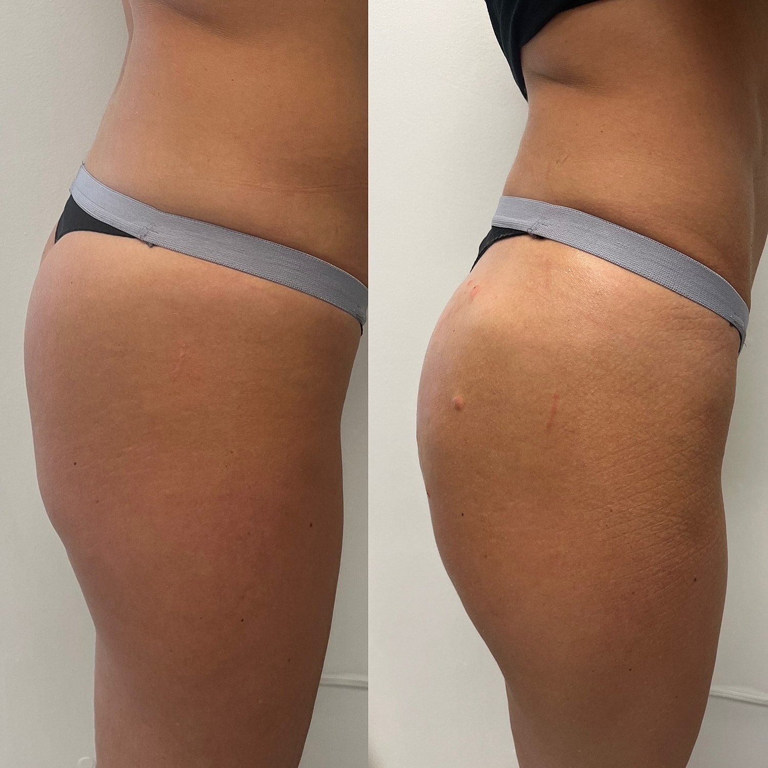 Dermal Fillers Before & After