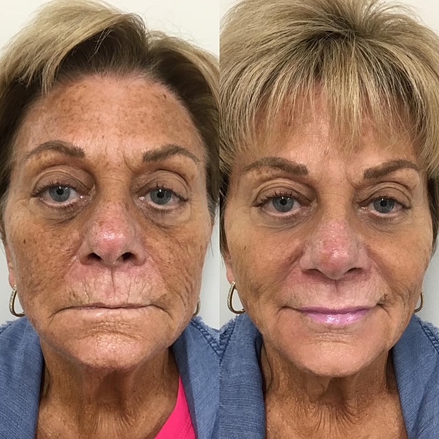 Facial Balancing Before & After
