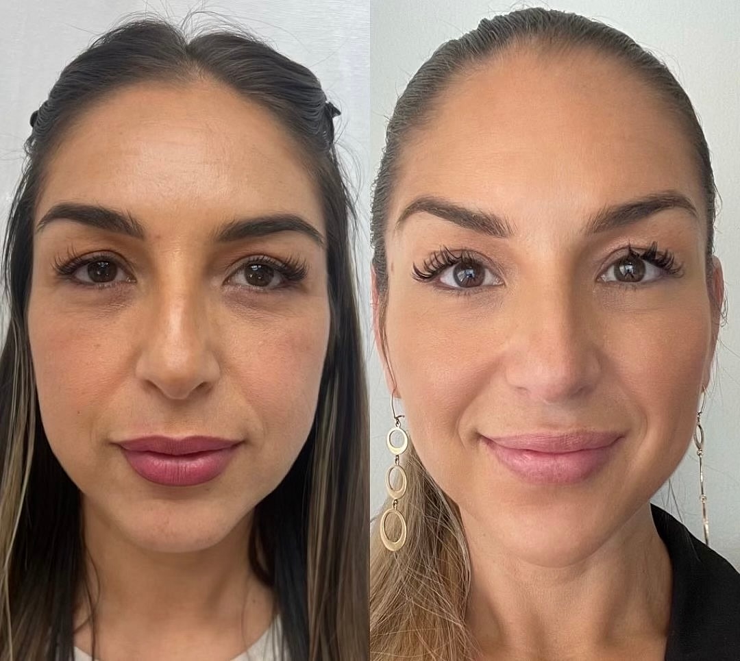 Facial Balancing Before & After