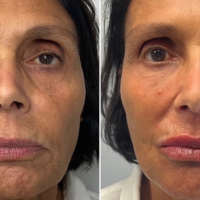 Facial Balancing Before & After