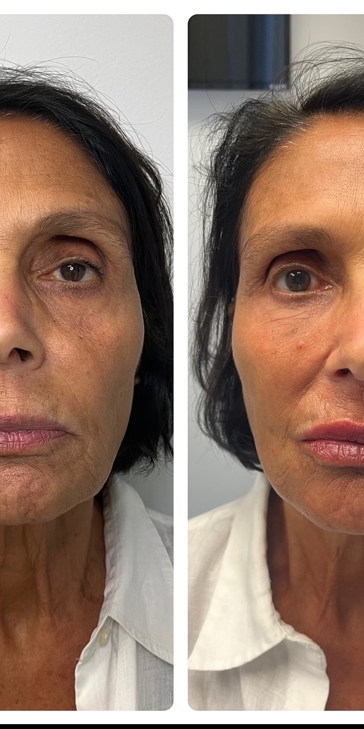 Facial Balancing Before & After