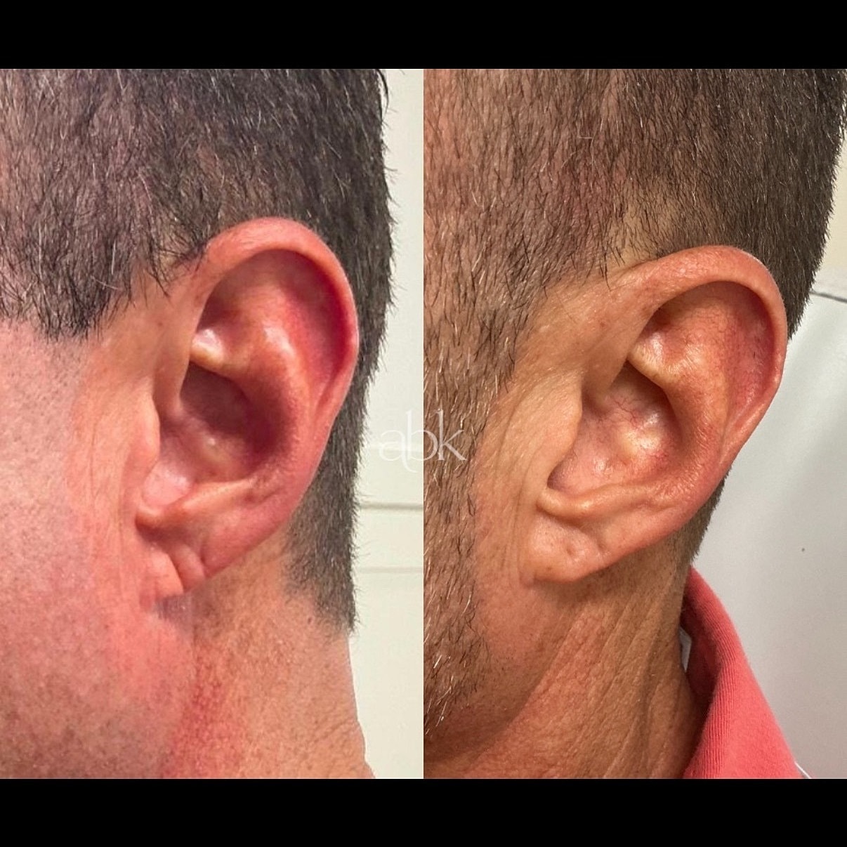 Facial Balancing Before & After